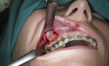 Na het wegschuiven van het tandvlees wordt het onderliggende kaaksbeen zichtbaar.