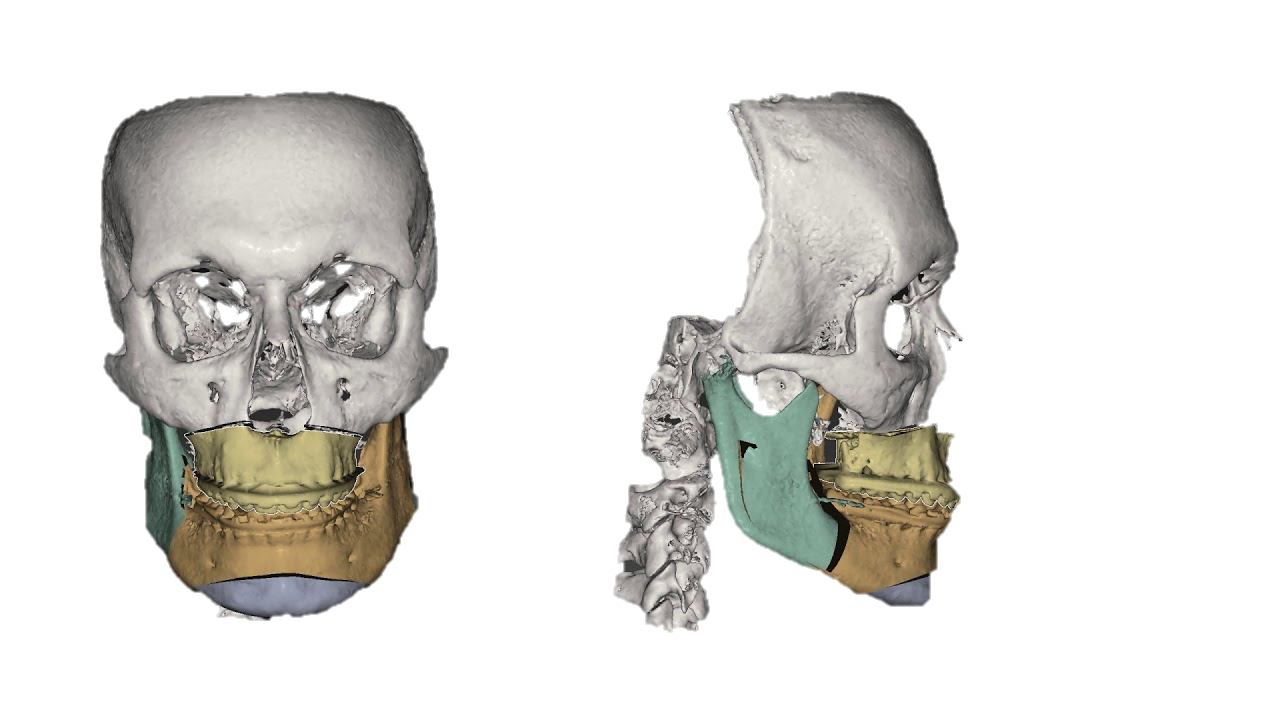 3D-planning van een kaakoperatie op een computermodel van de schedel, vooraan- en zijaanzicht