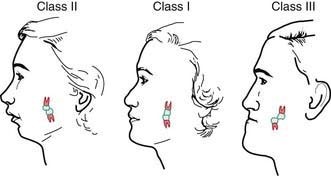 Gezichtsprofielen bij Angle klasse II (terugwijkende kin), klasse I (normaal) en klasse III (vooruitstekende kin)