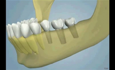 Stap 3: na 4 tot 6 maanden ingroei zijn implantaten met kronen in het opgebouwde bot geplaatst