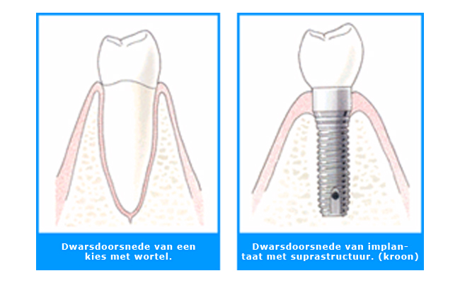 Dwarsdoorsnede van een kies met wortel naast een implantaat met kroon