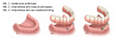 Tandeloze onderkaak, klikprothese op twee drukknoppen en klikprothese op een staaf