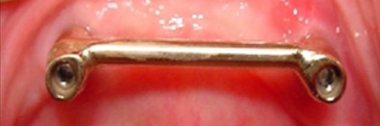 Metalen staaf tussen twee implantaten in de onderkaak, waarop de prothese vastklikt
