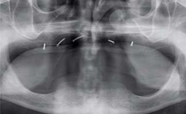 Panoramische röntgenfoto van tandeloze kaken vóór het plaatsen van implantaten