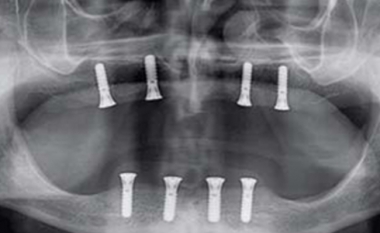Panoramische röntgenfoto met vier implantaten in de bovenkaak en vier in de onderkaak