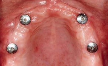 Vier implantaten met afdekschroefjes zichtbaar in het tandvlees van de bovenkaak