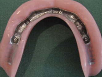 De bevestigingsconstructie en de prothese De bevestigingsconstructie en de prothese