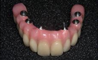 De bevestigingsconstructie en de prothese De bevestigingsconstructie en de prothese