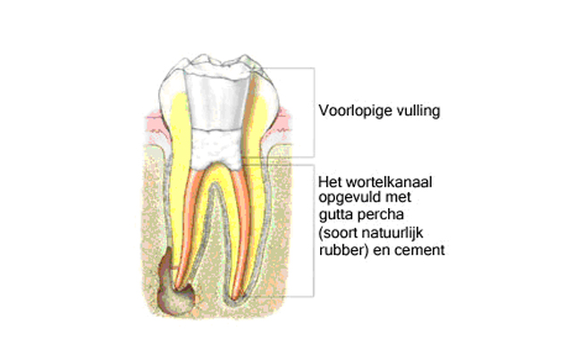 Kies na een wortelkanaalbehandeling: kanalen gevuld met guttapercha en cement, met een voorlopige vulling