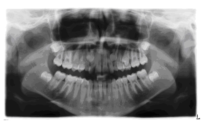 Panoramische röntgenfoto van een jong gebit met een niet doorgebroken hoektand in de kaak